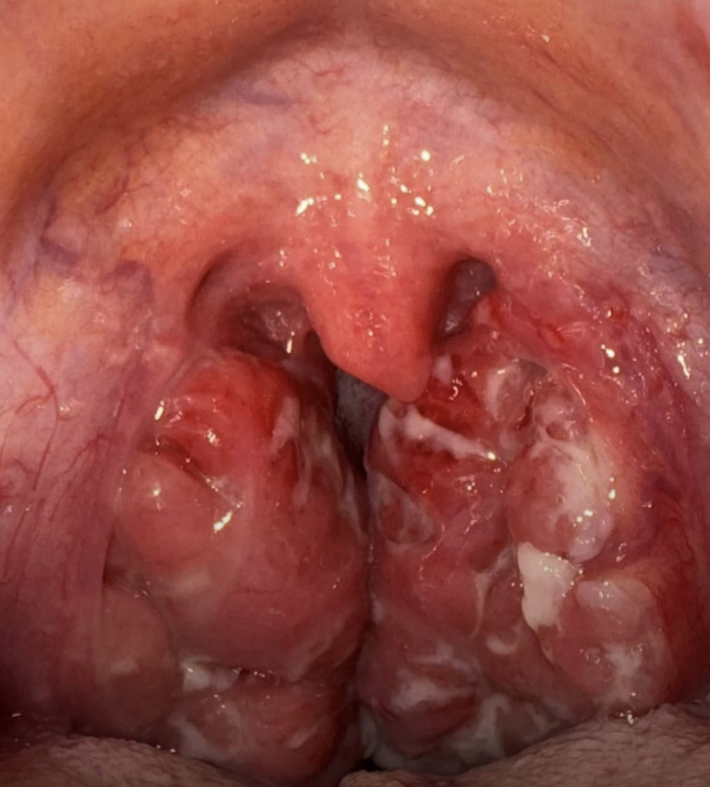 Chronic Tonsil Inflammation and Abnormal Growths: Amyloid Aggregation?
