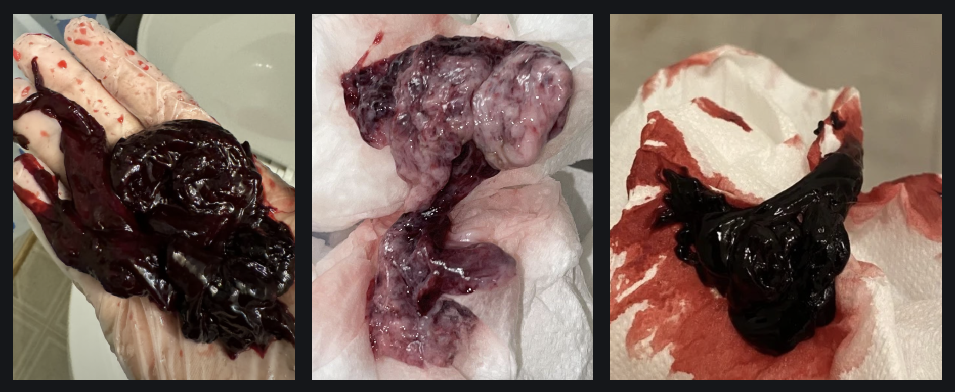 Massive Clots and Fleshy Tissue: 2 Years of Increasing Incidence on r/Periods