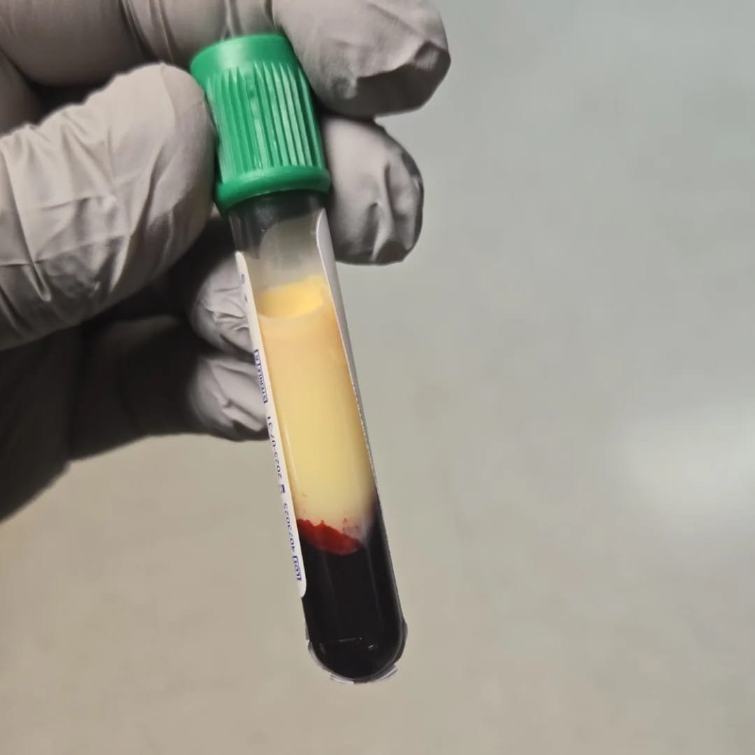 "Strawberry Milk" Phenomena: What's Collecting in our Blood?
