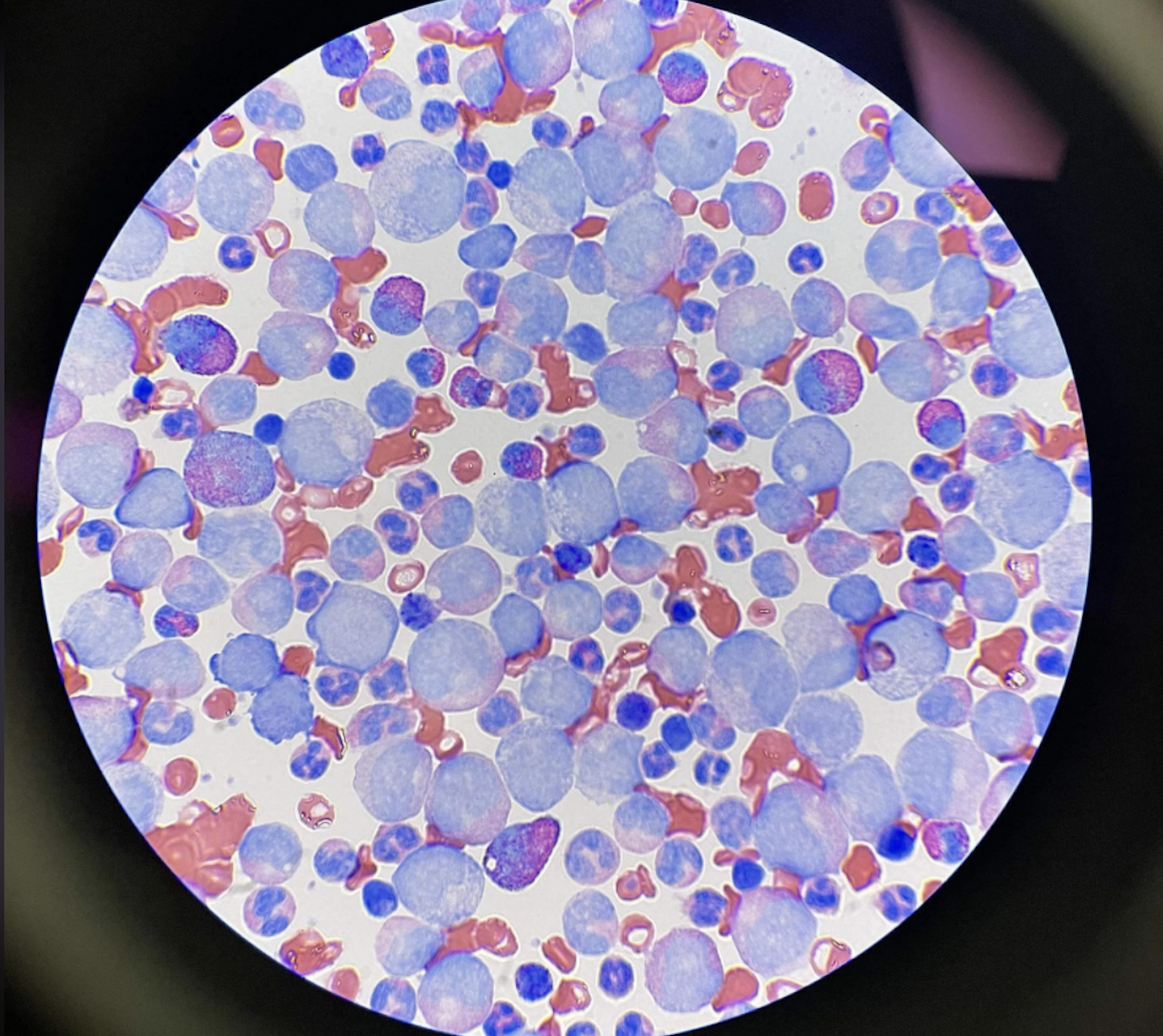 Cancer of the Immune Cells: A Snapshot of Leukemia From r/MedLabProfessionals And A Breakdown Of The Literature
