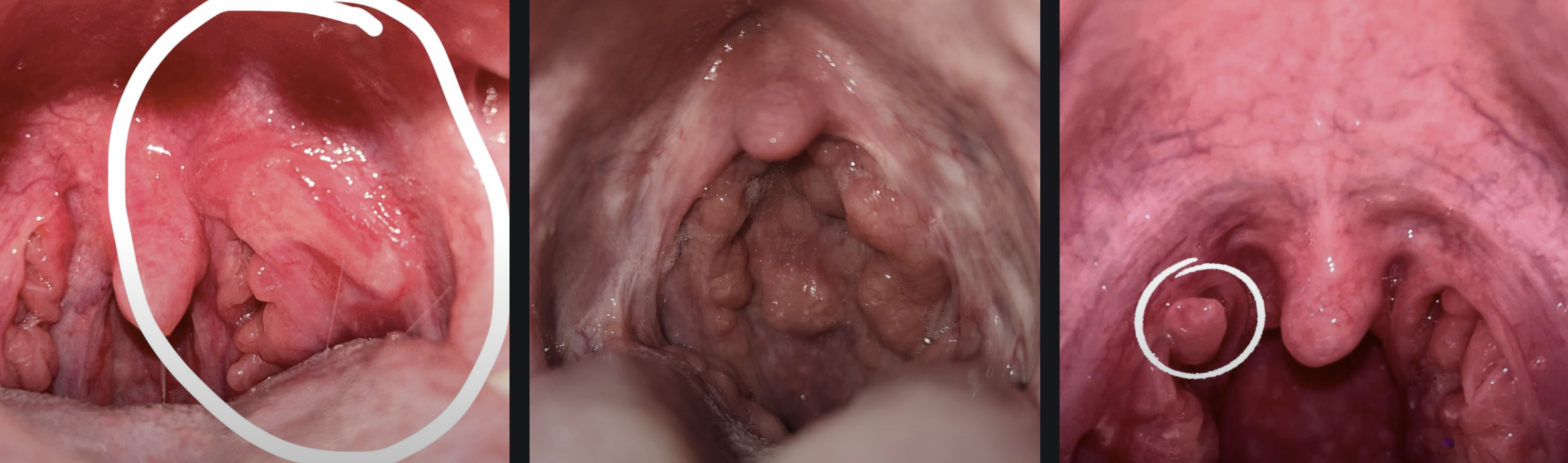 An Update To The Chronic Tonsil And Throat Saga