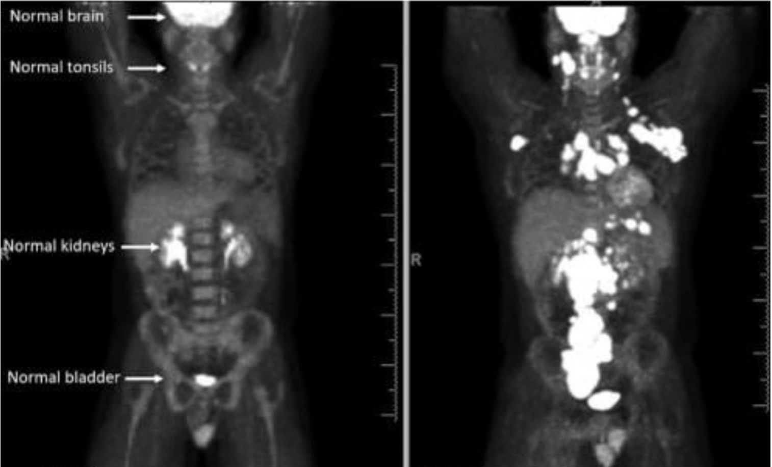 Severe, Sudden Lymphoma Diagnosis Under 30