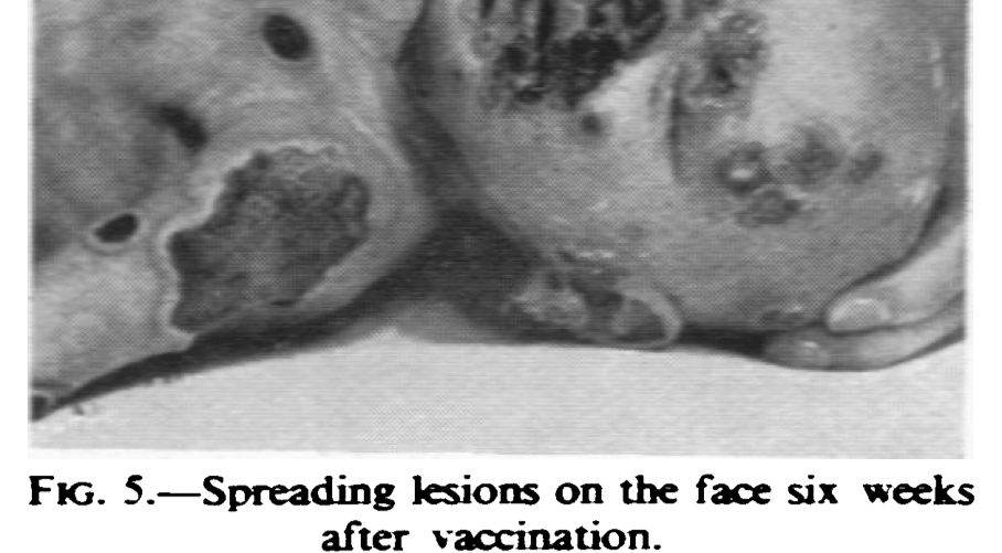 A Visual, Horrific History Of The Smallpox Vaccine (The Narrative We Know Is A Complete Lie)