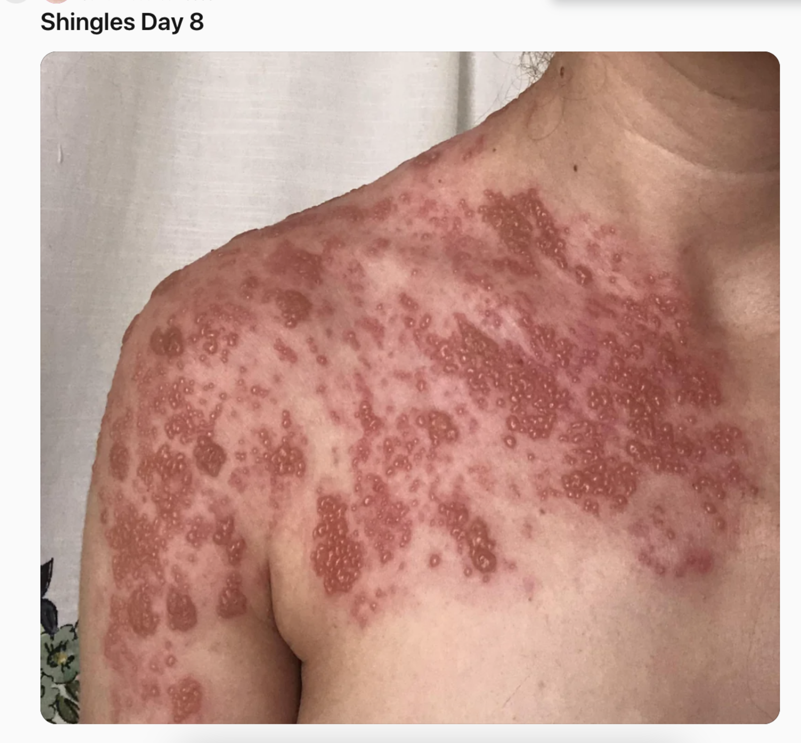We "Beat" Chicken Pox With Vaccination... And Replaced It With Something Way Worse?